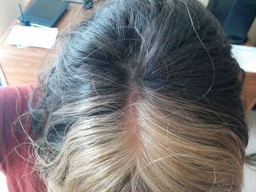 This Person Who Was Born With Both Brown And Blonde Hair
