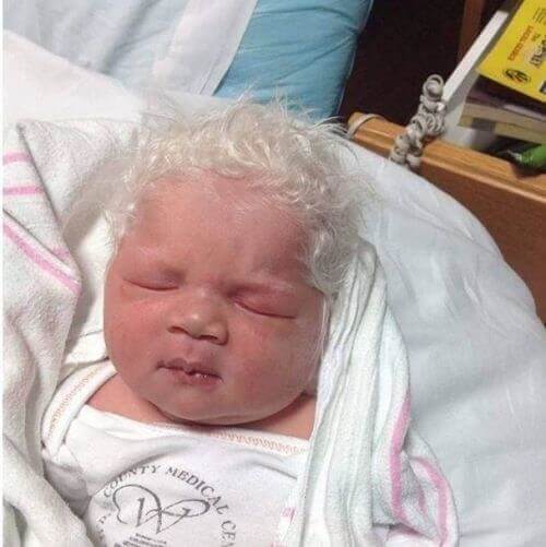 ​A Baby Who Born With White Hair