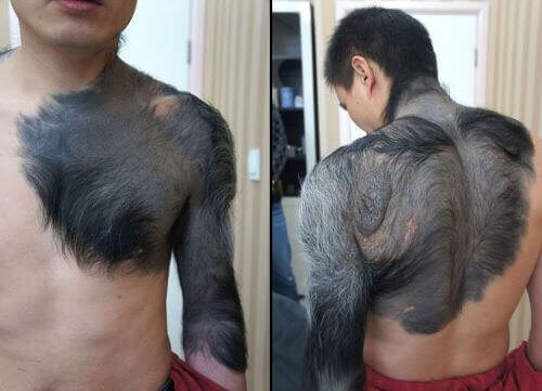 ​This Guy Who Was Born With Werewolf Syndrome