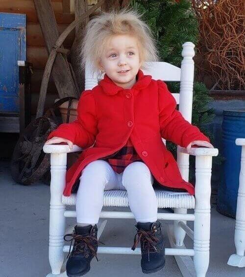 A Toddler Who Was Born With Uncombable Hair Syndrome