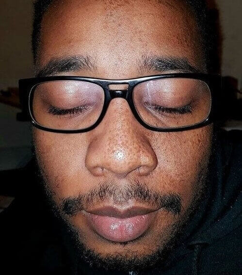 Man With Freckles On Half Of His Face