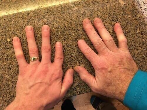 This Daughter Who Was Born With The Same Sized Finger As Her Dad